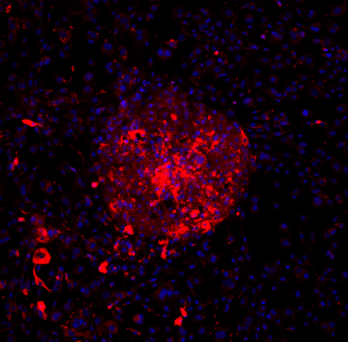 Micropatterned primary human hepatocytes dosed with free fatty acids and stained for lipid accumulation (red) and DAPI (blue).
                  