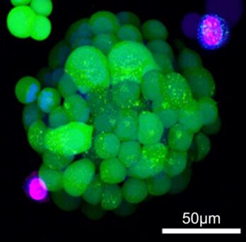 A lung cancer organoid simulating a cluster of tumor cells for drug screening. 